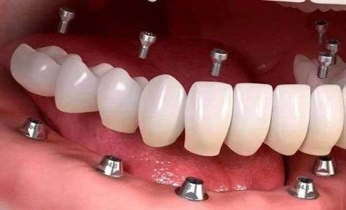 دو نوع ایمپلنت مرسوم در دنیا چیست؟