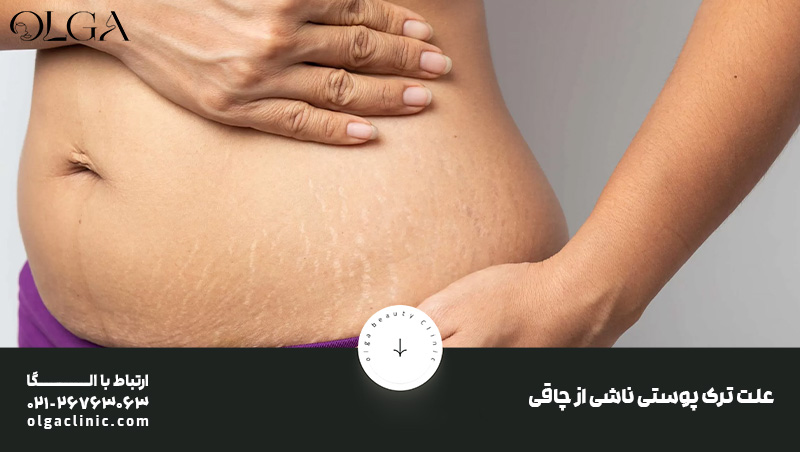 درمان | روغن تنها و موثرترین راه درمان ترک پوستی ناشی از چاقی