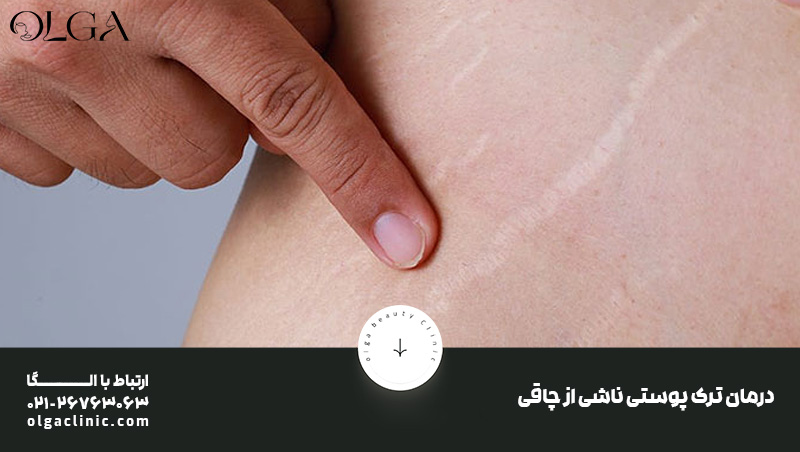 درمان | روغن موثرترین درمان ترک پوستی ناشی از چاقی
